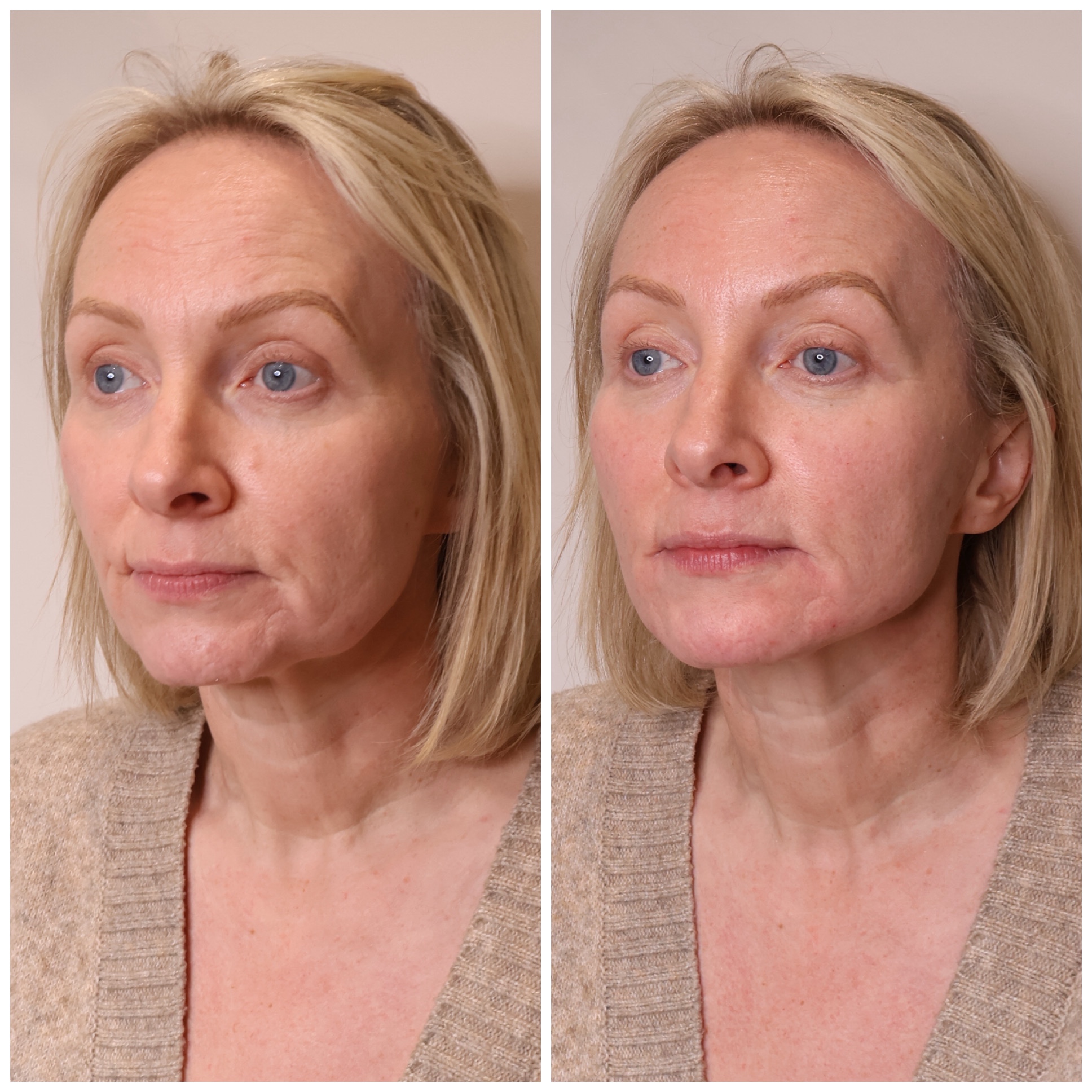 Before and after aesthetic treatment result