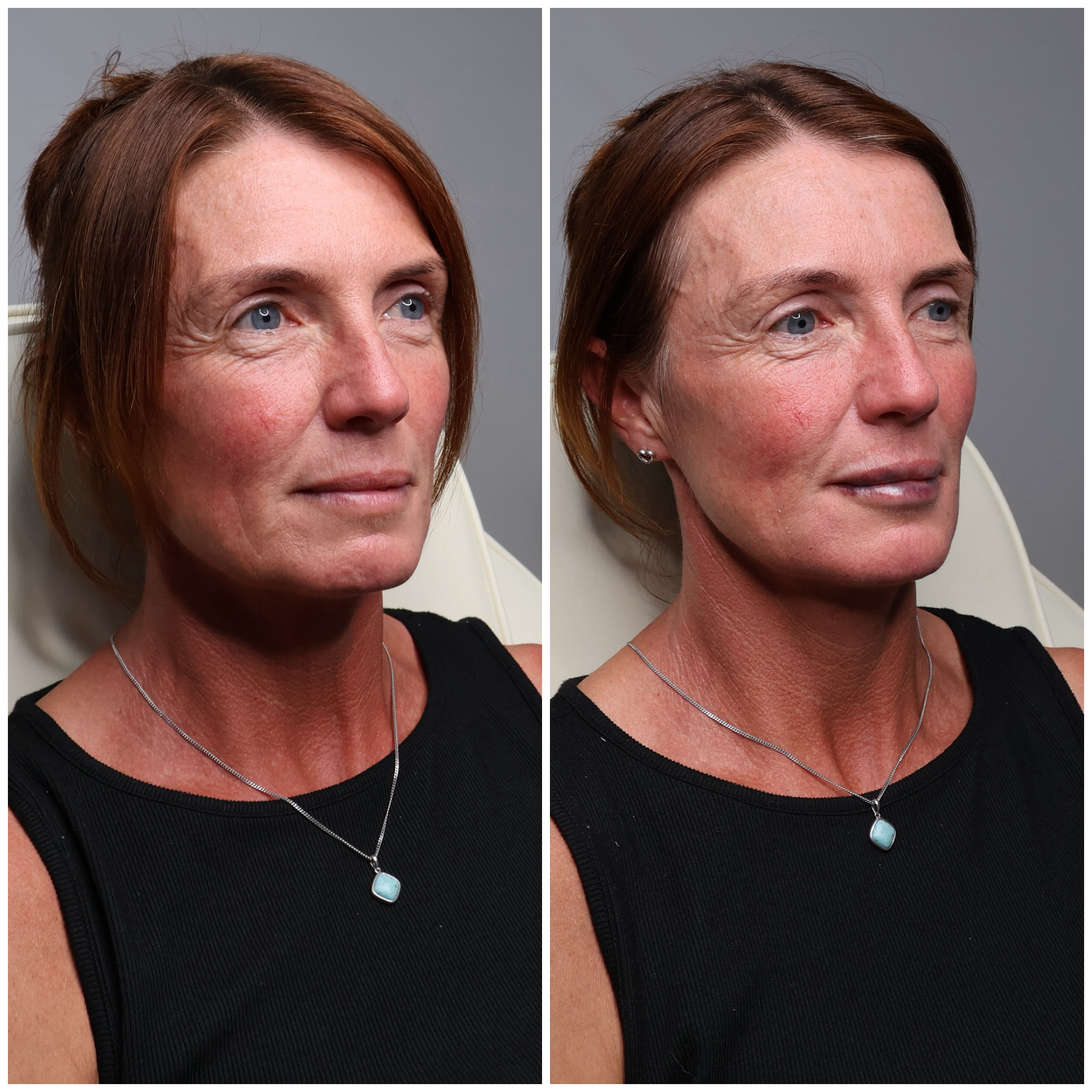 Before and after aesthetic treatment result