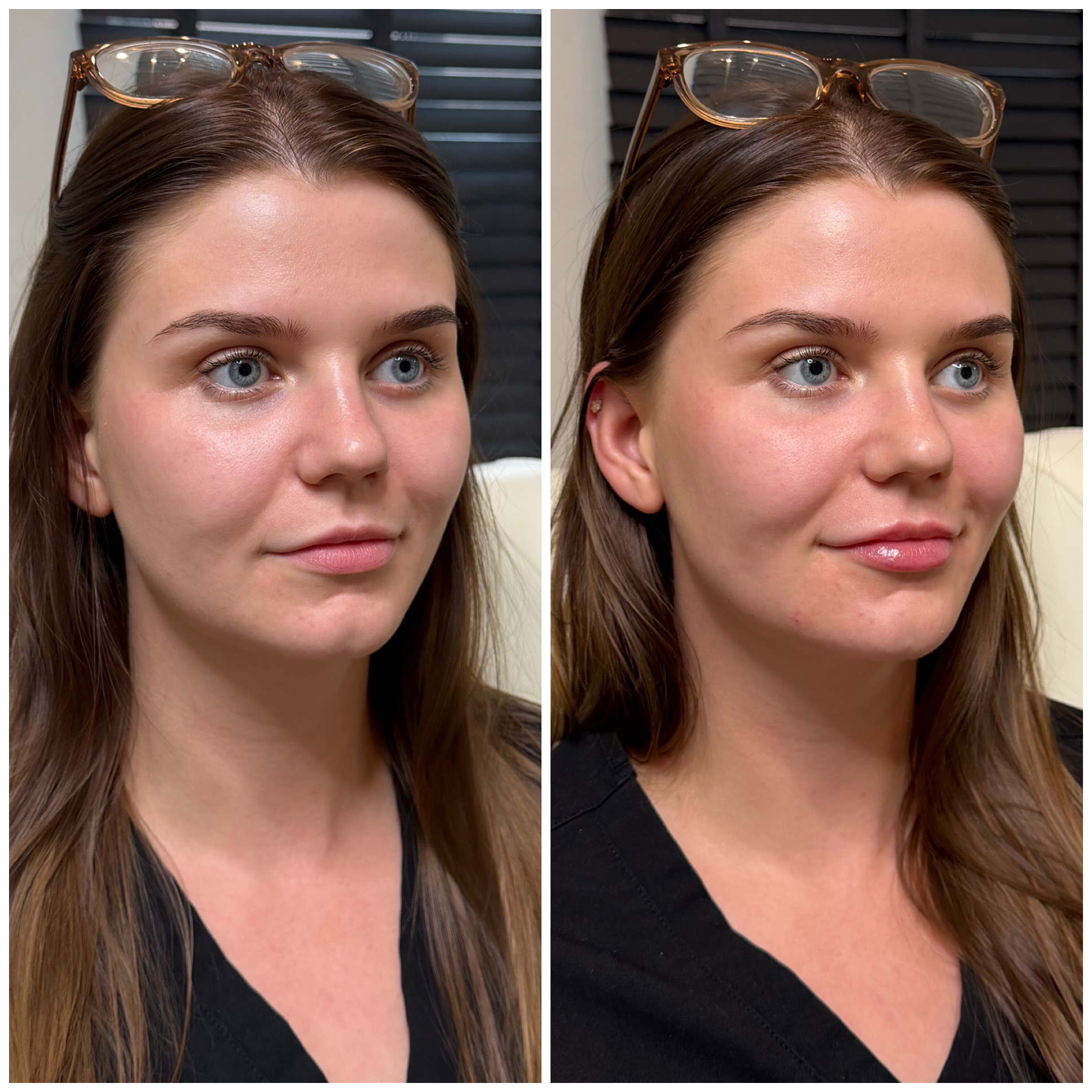 Before and after aesthetic treatment result