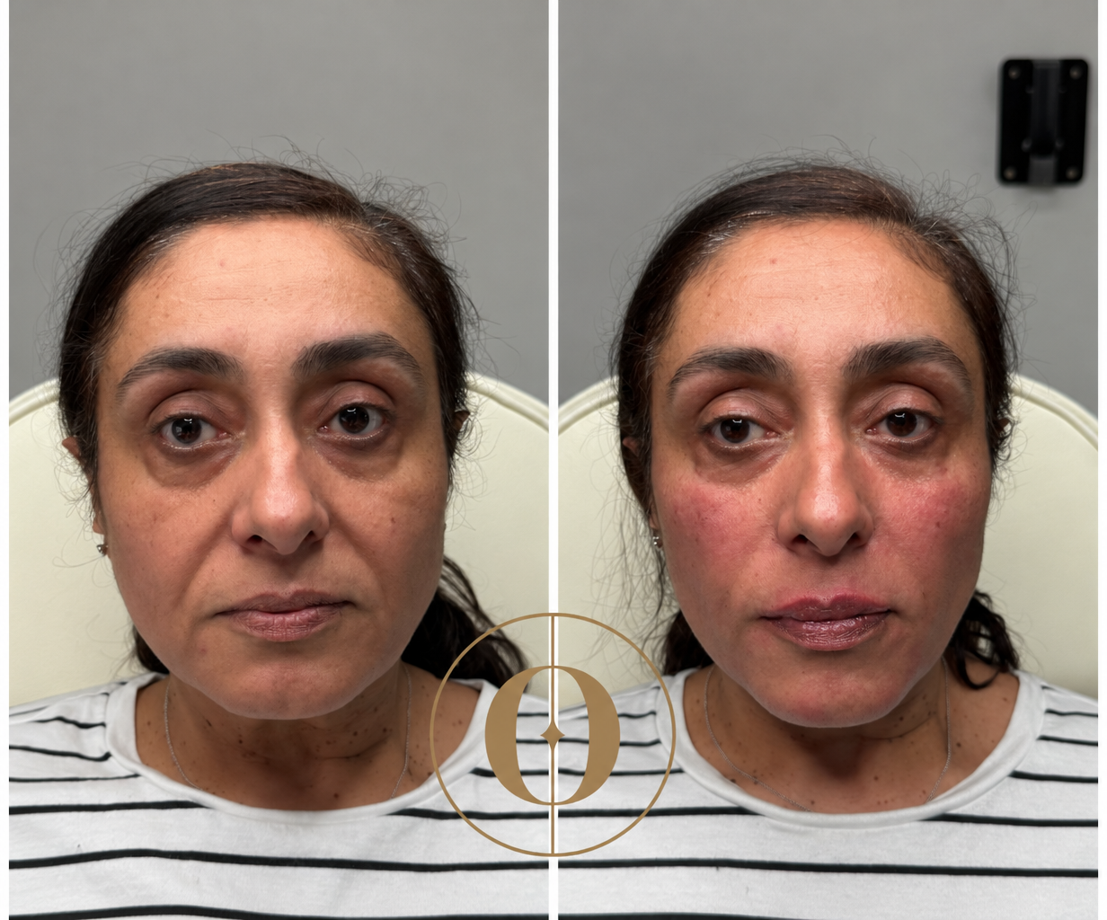 Before and after aesthetic treatment result