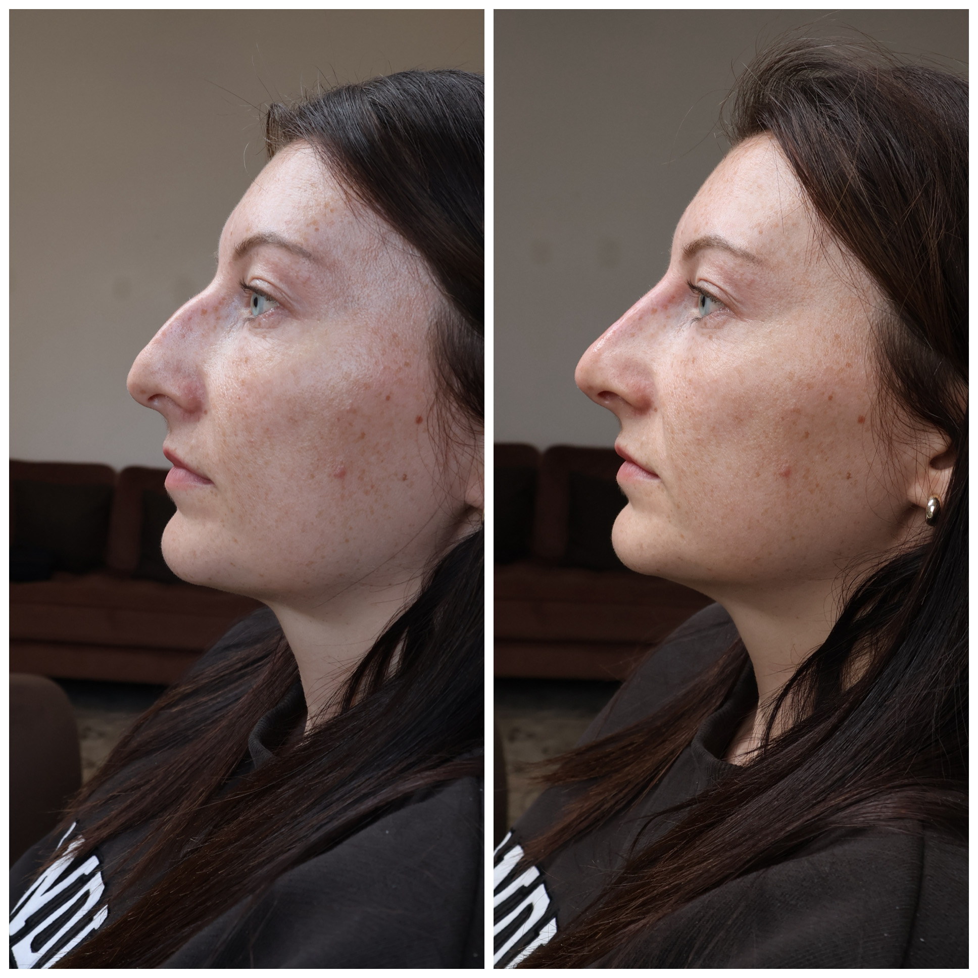 Before and after nose treatment result