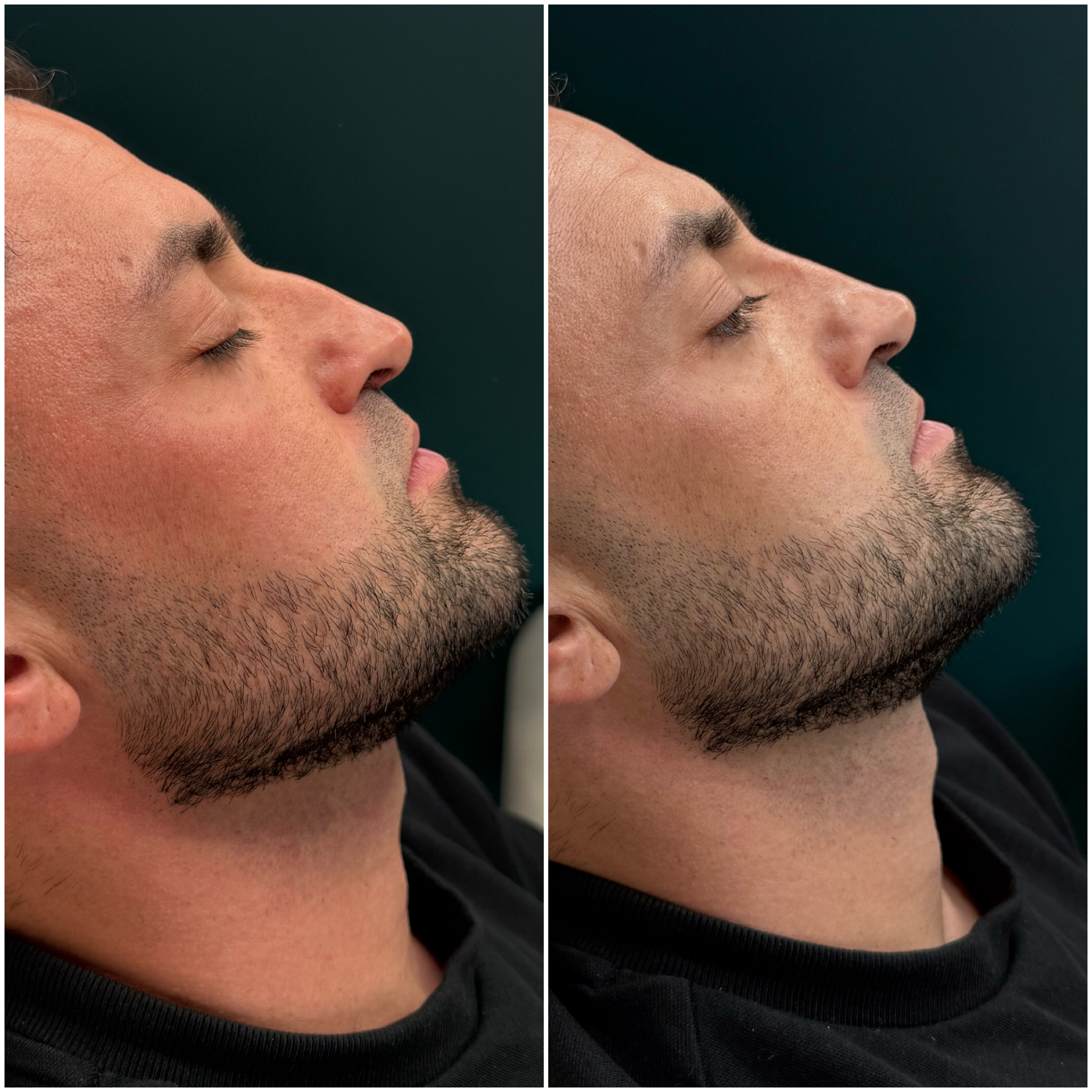 Before and after nose treatment result