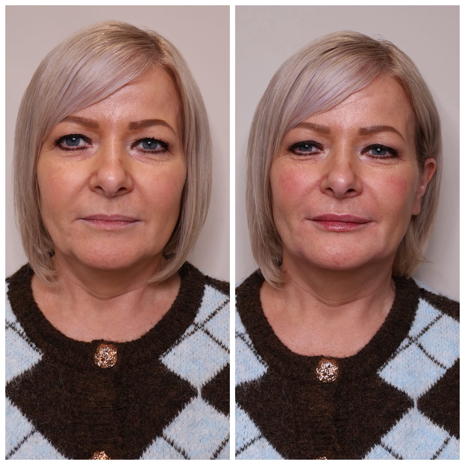 Before and after aesthetic treatment result