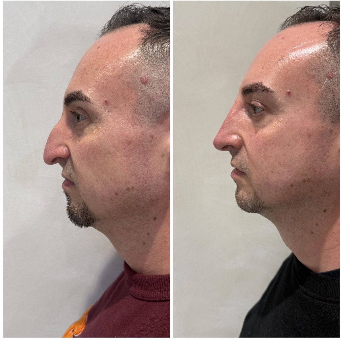 Before and after nose treatment result