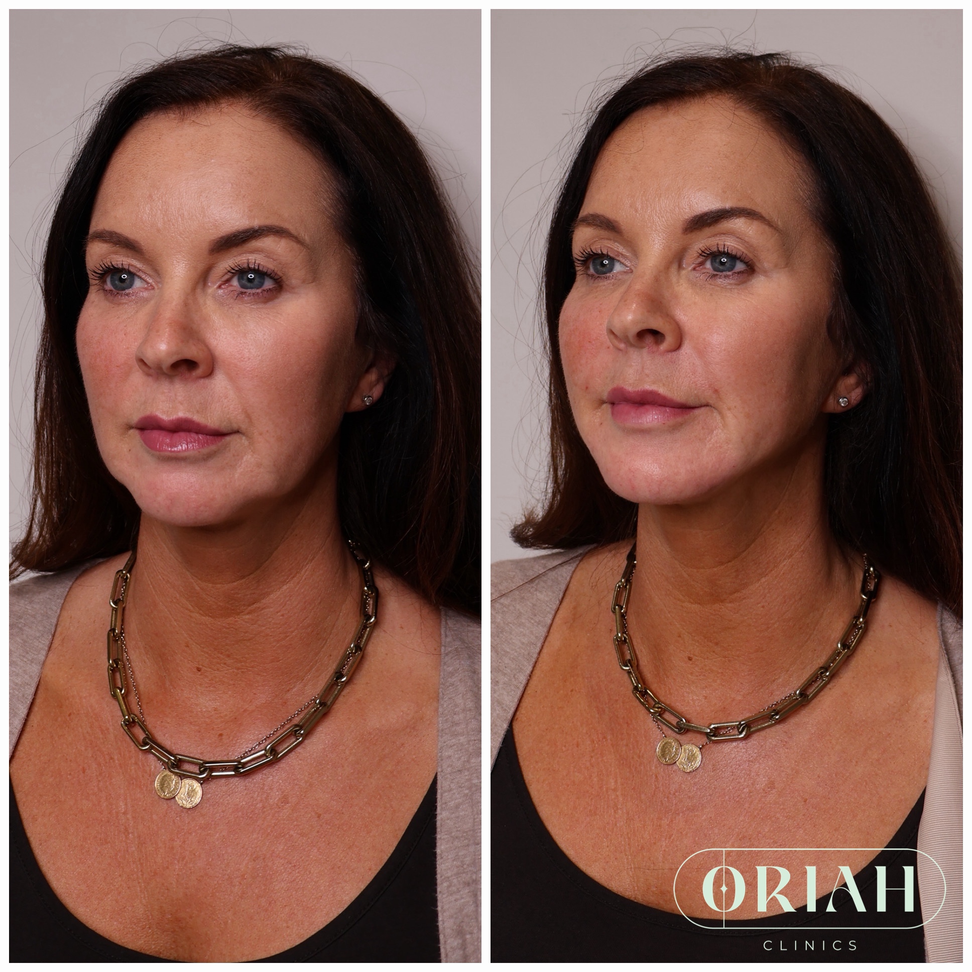 Before and after aesthetic treatment result