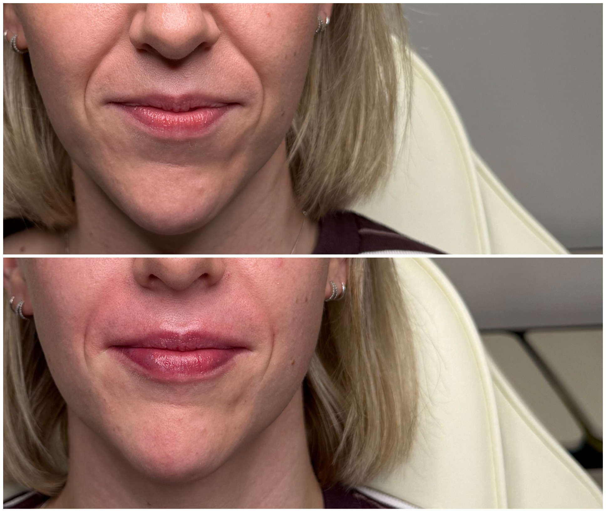 Before and after lip filler result