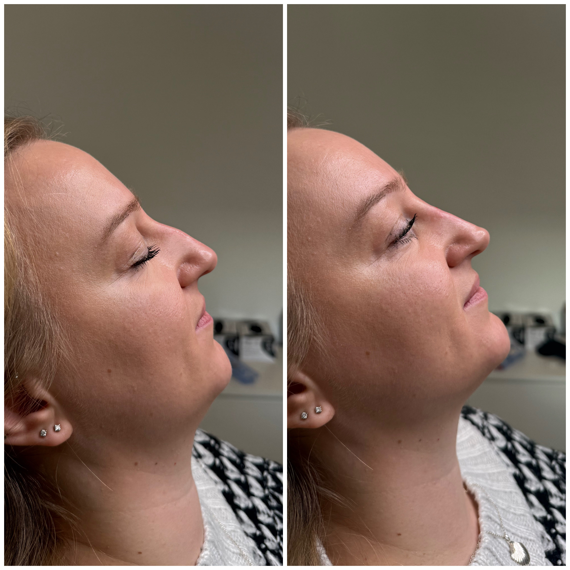 Before and after nose treatment result