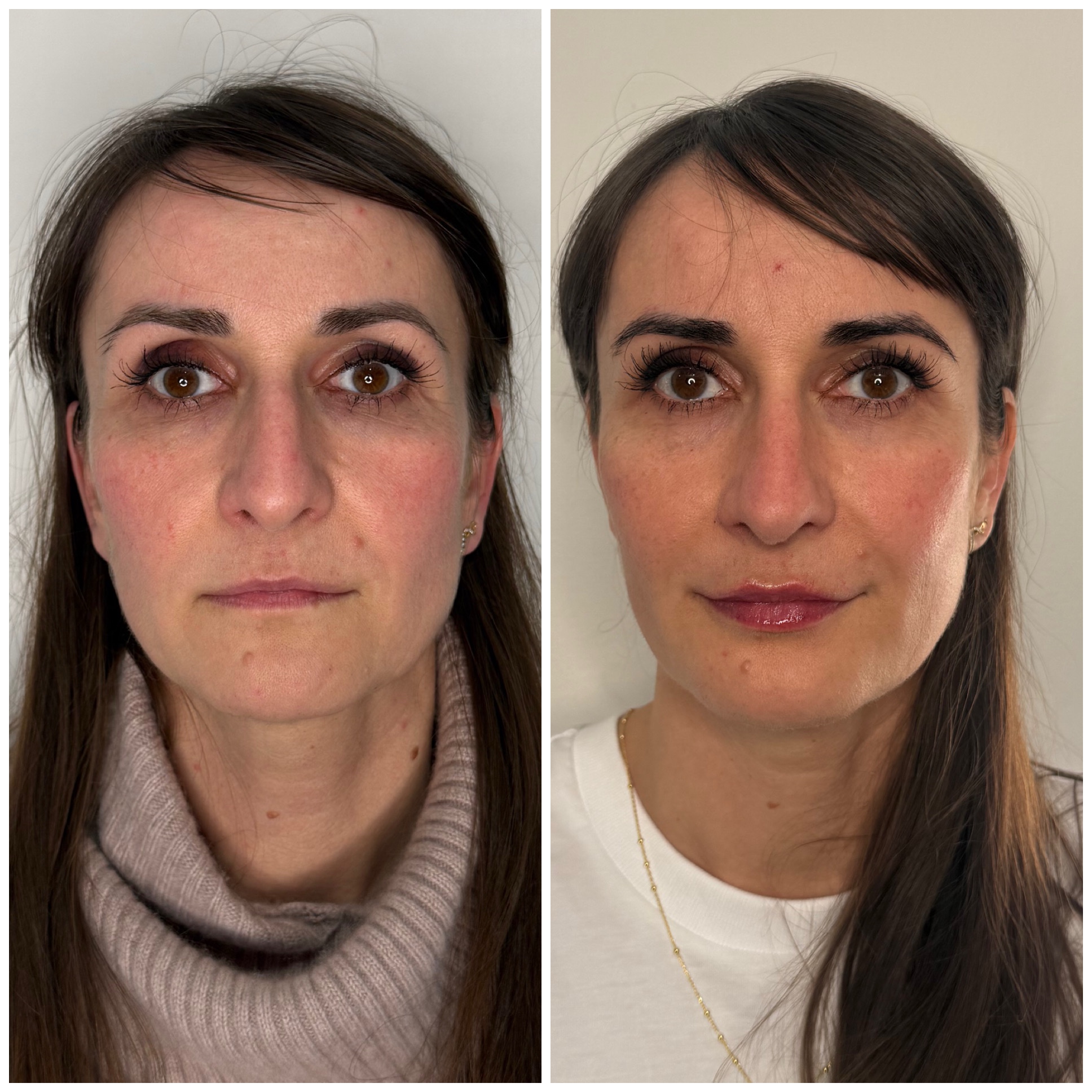 Before and after aesthetic treatment result