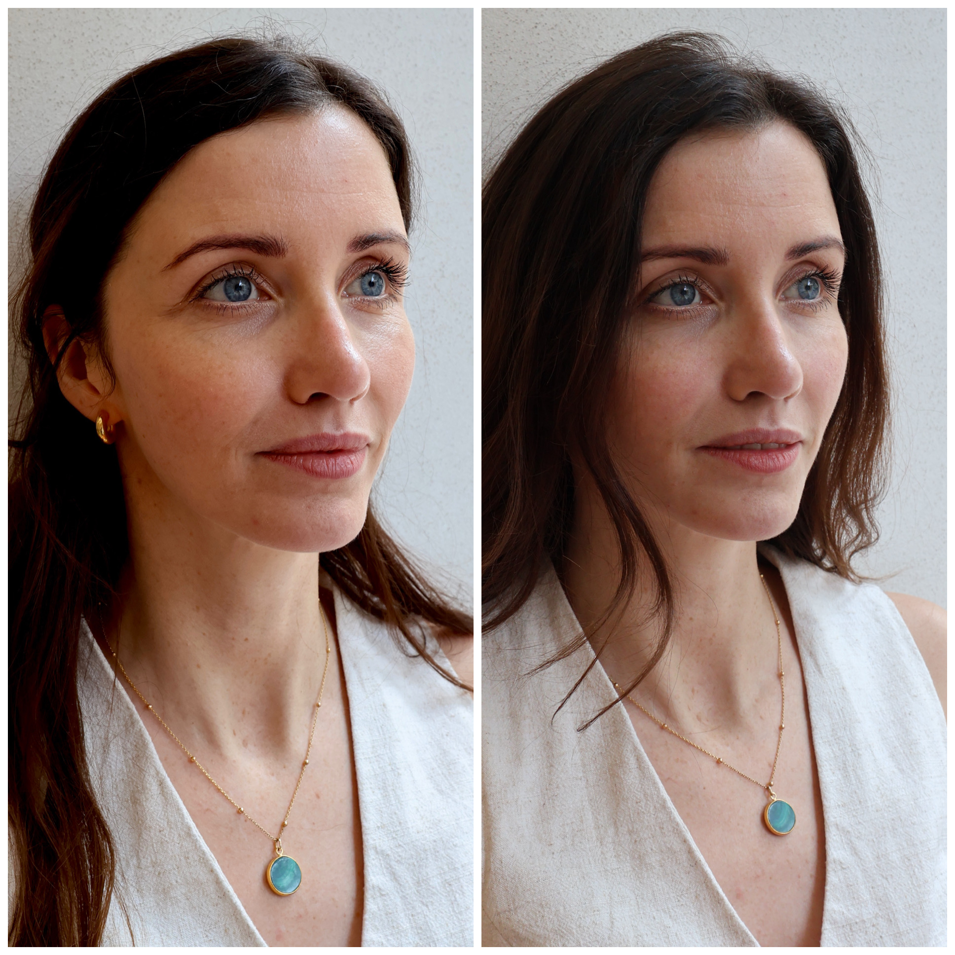 Before and after aesthetic treatment result