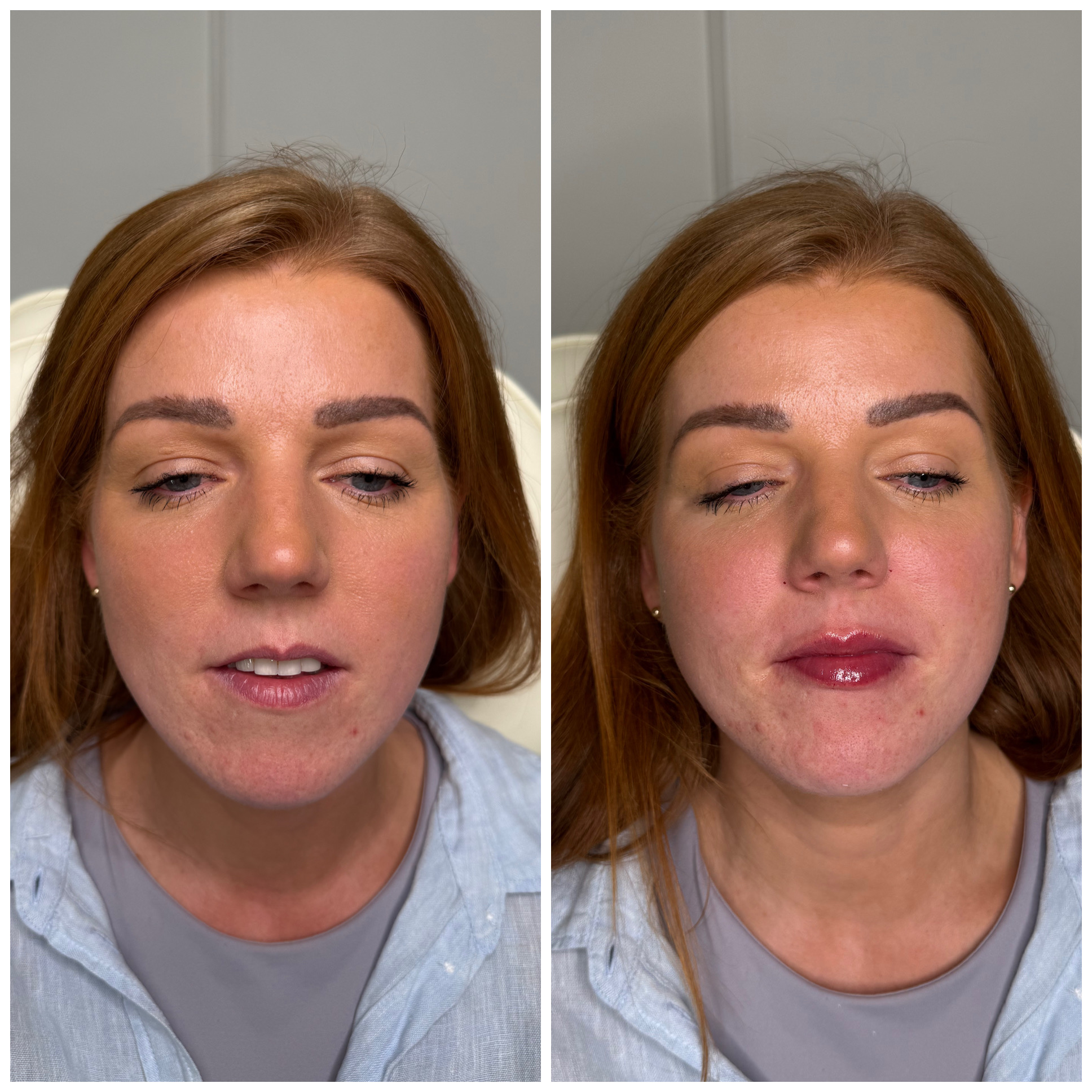 Before and after lip treatment result