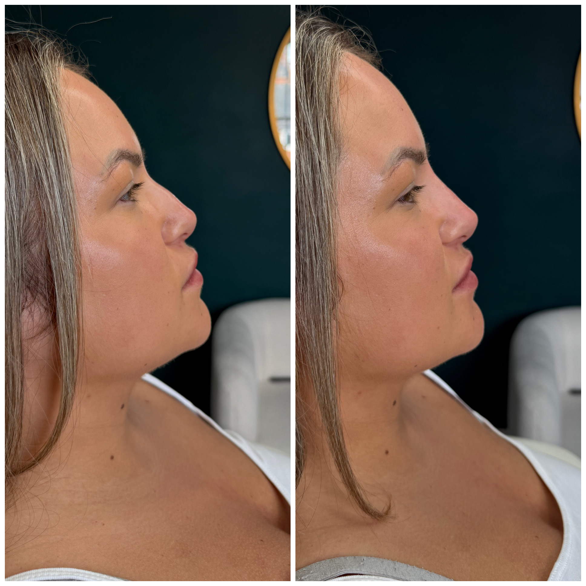 Before and after nose treatment result