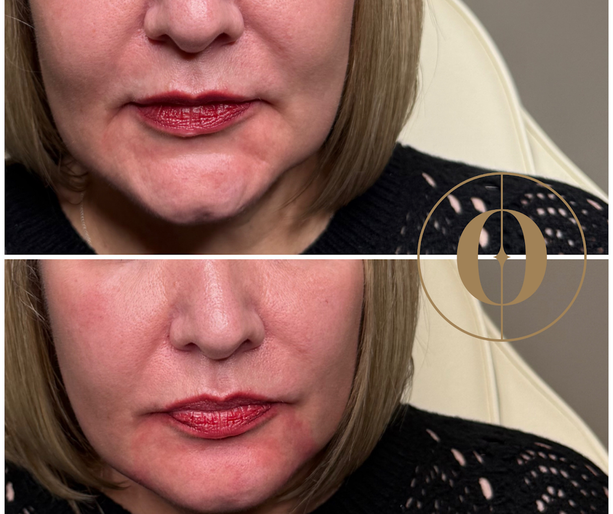 Before and after dermal filler result