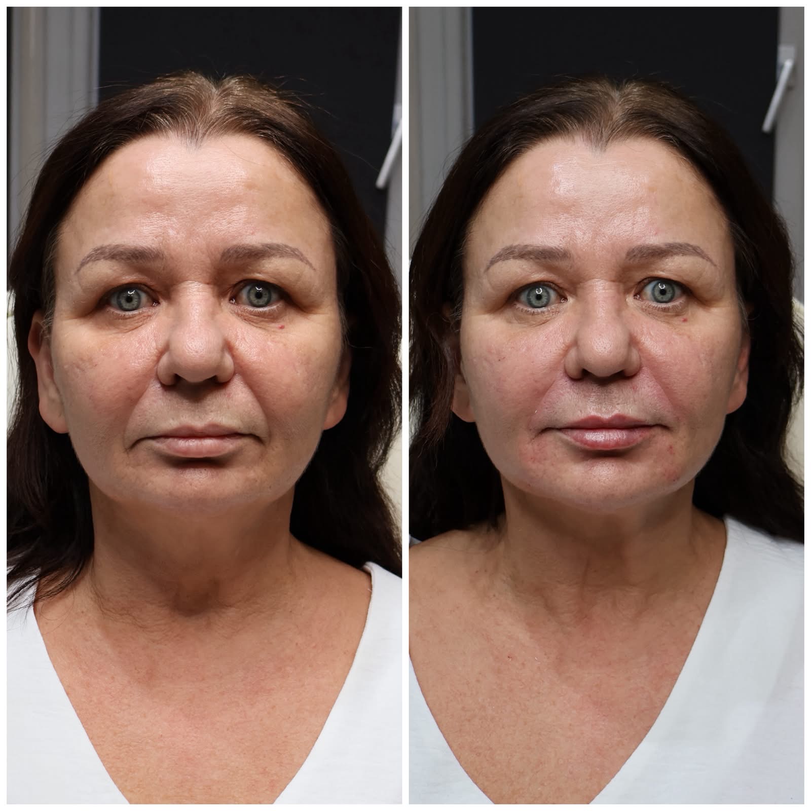 Before and after aesthetic treatment result