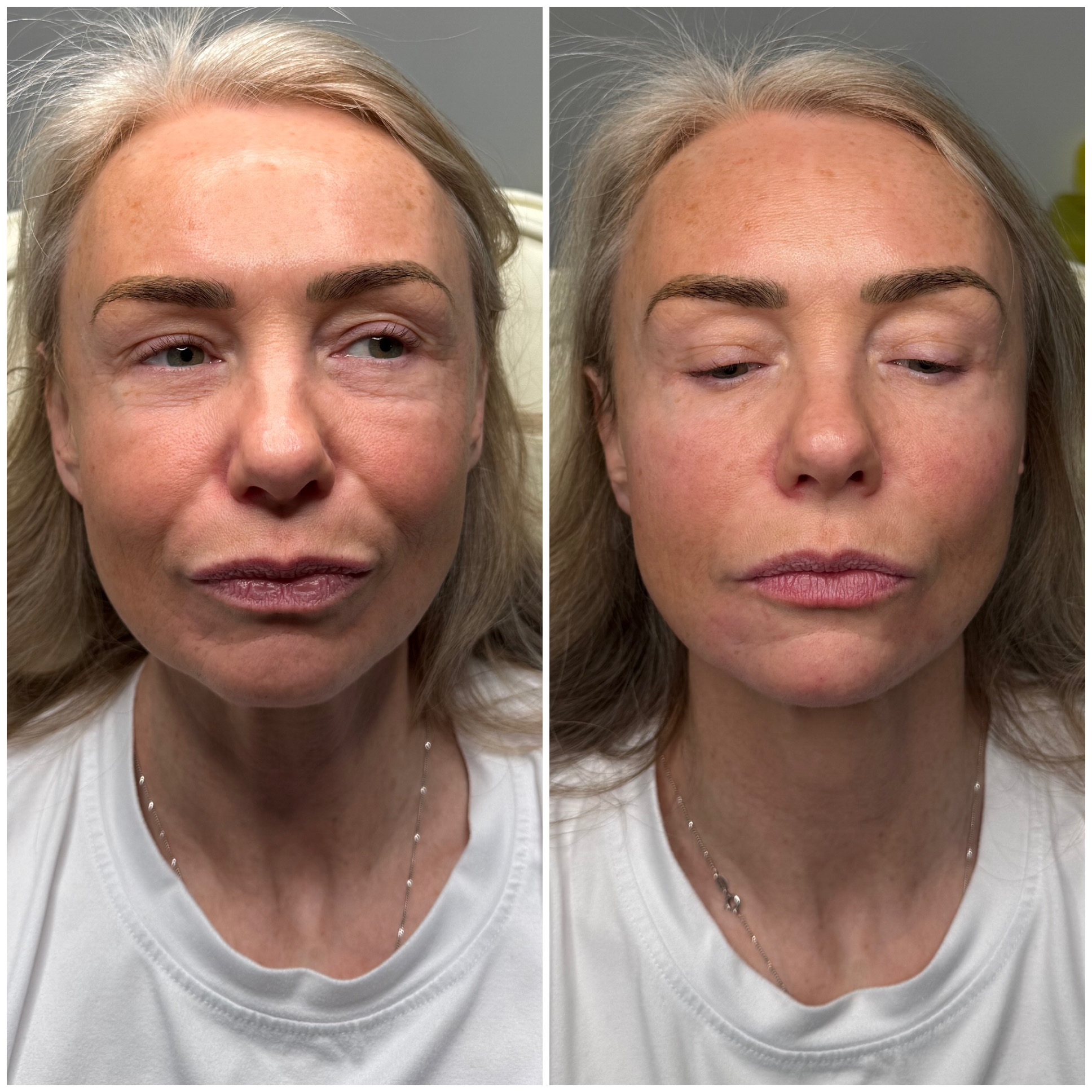 Before and after aesthetic treatment result