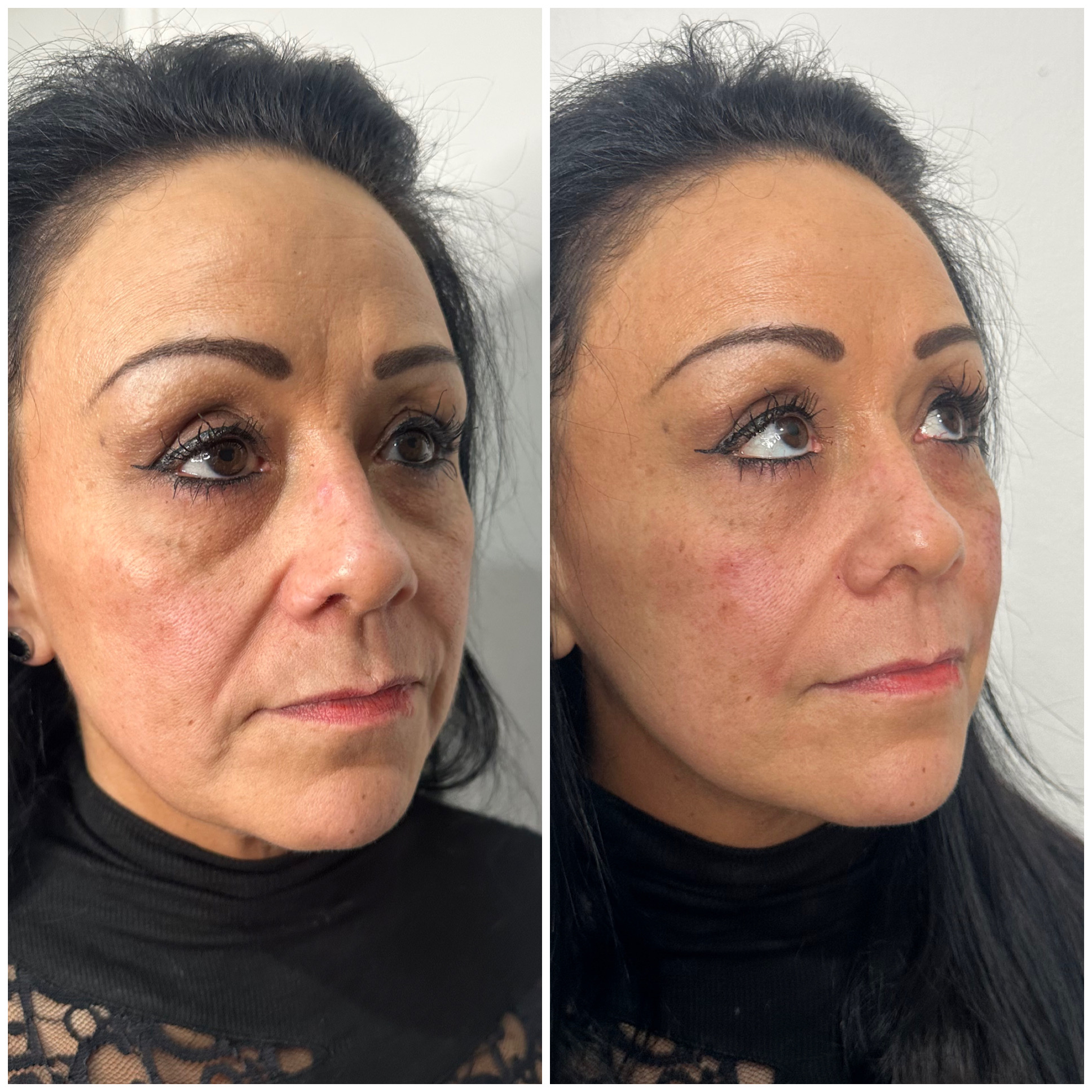 Before and after aesthetic treatment result