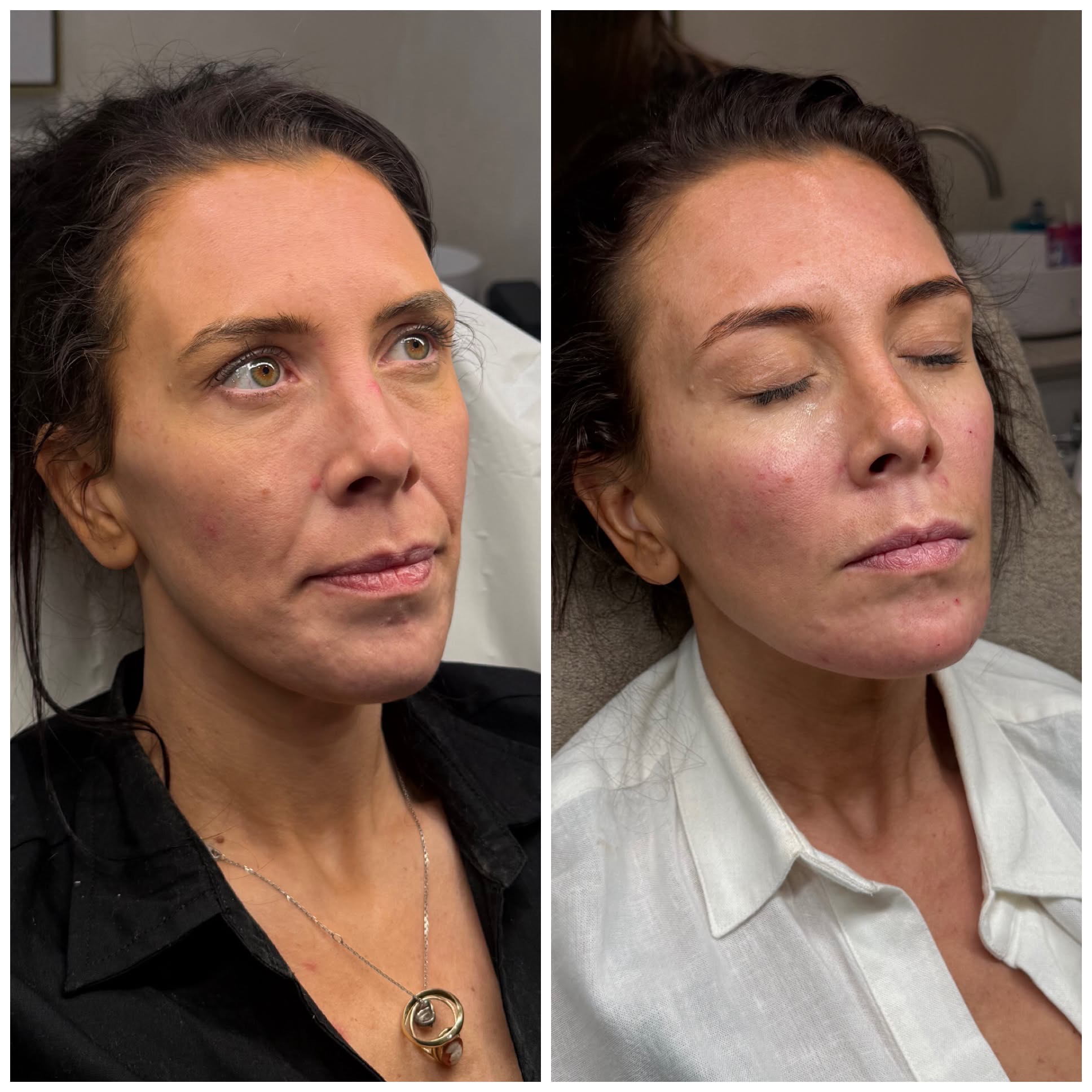 Before and after aesthetic treatment result