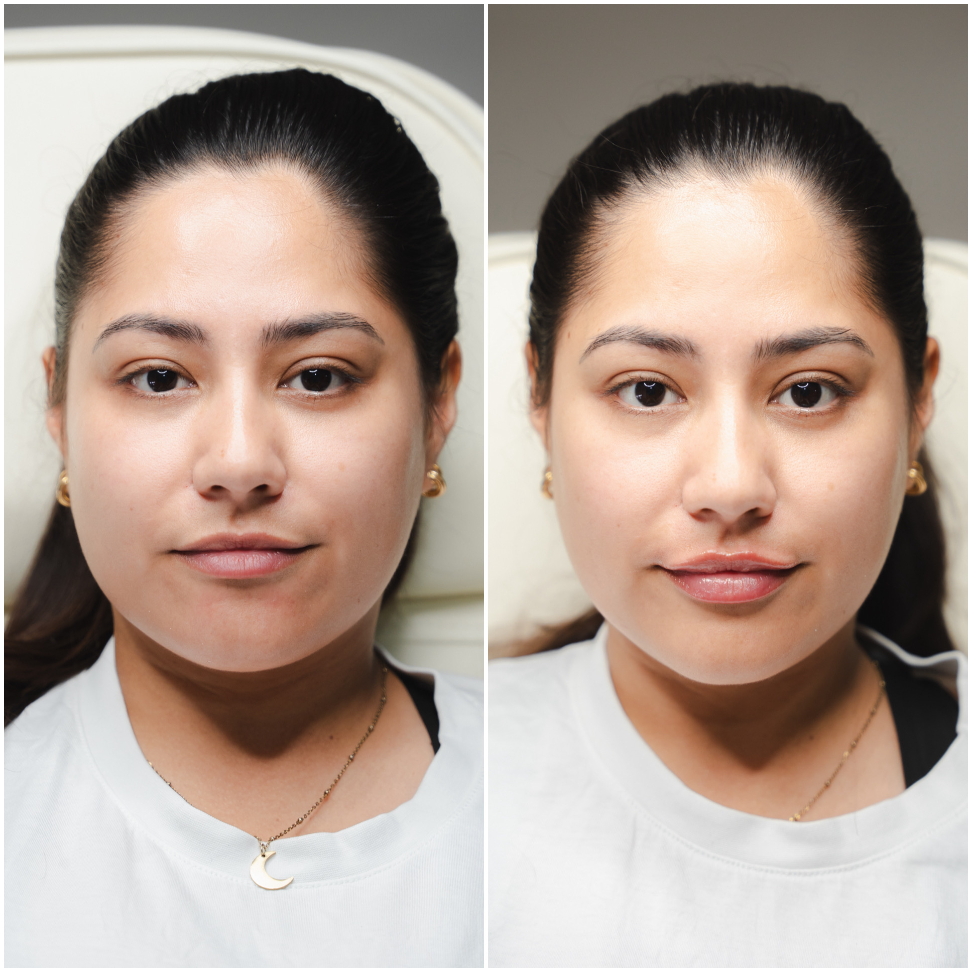 Before and after lip filler result