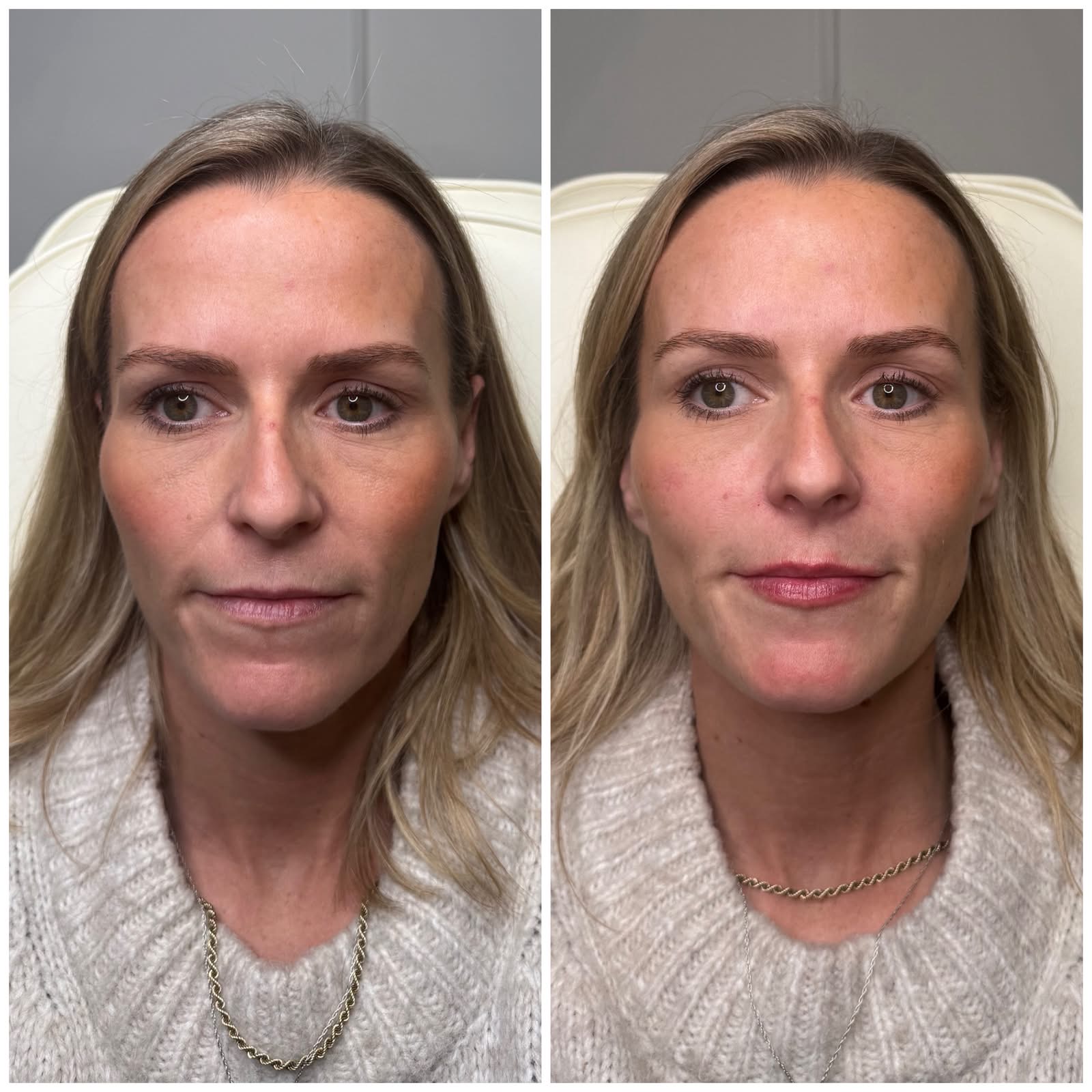 Before and after aesthetic treatment result