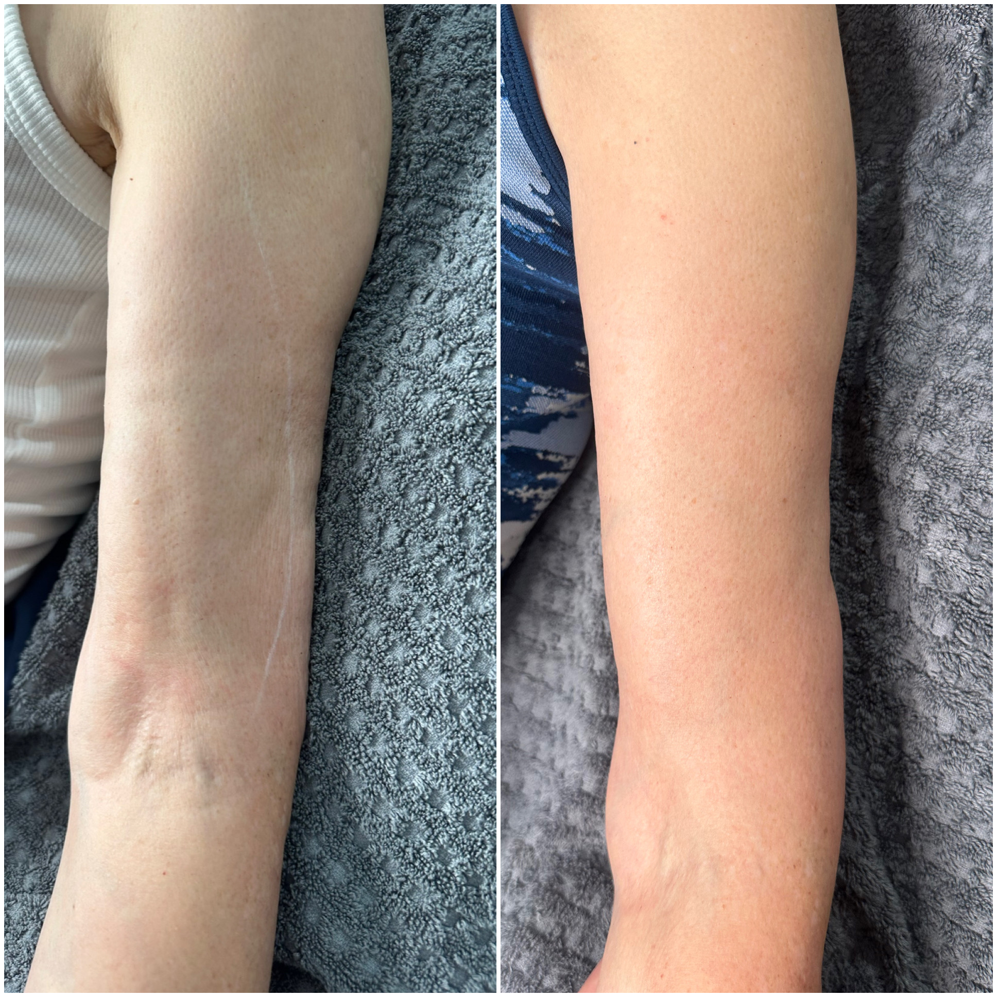 Before and after arm skin treatment result