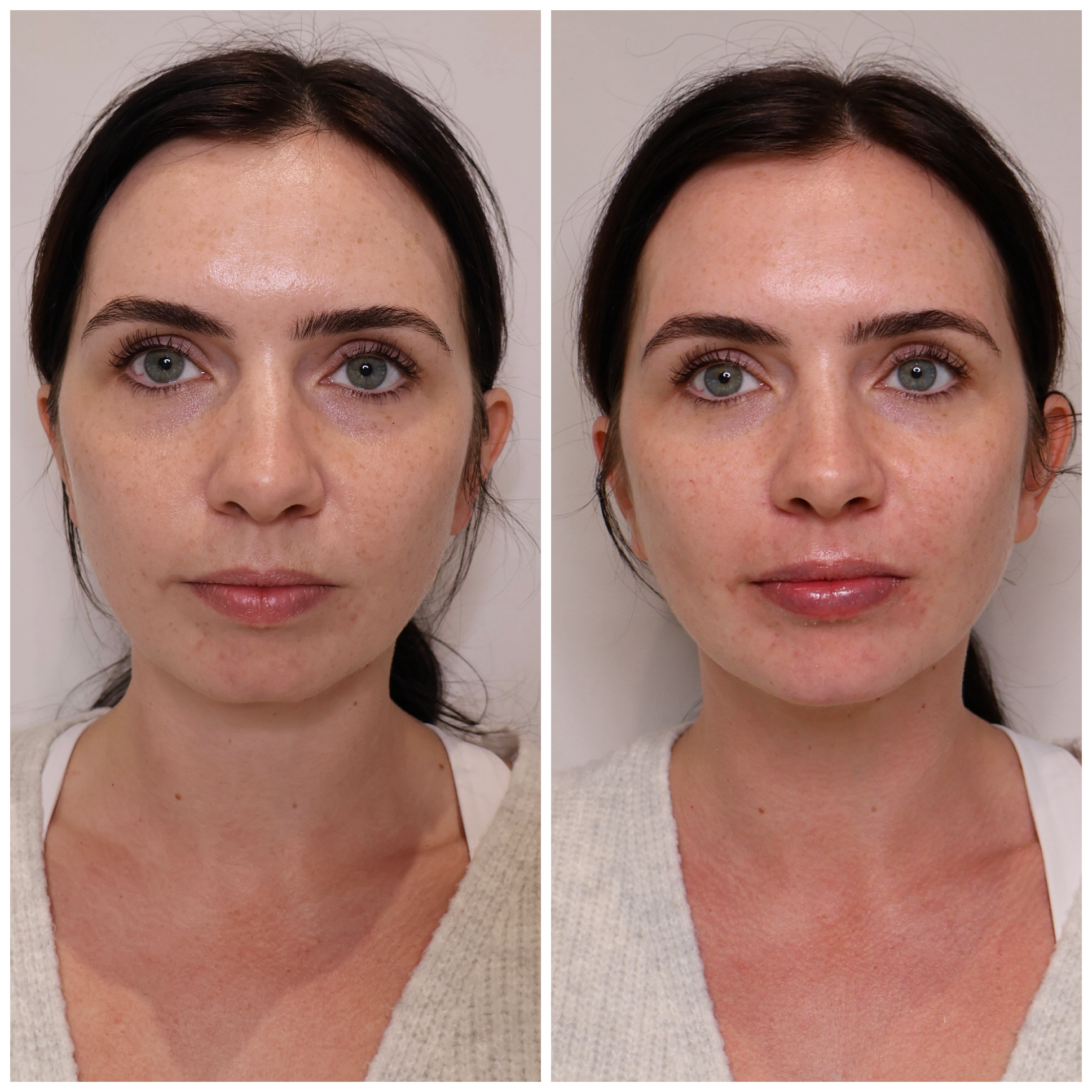Before and after aesthetic treatment result