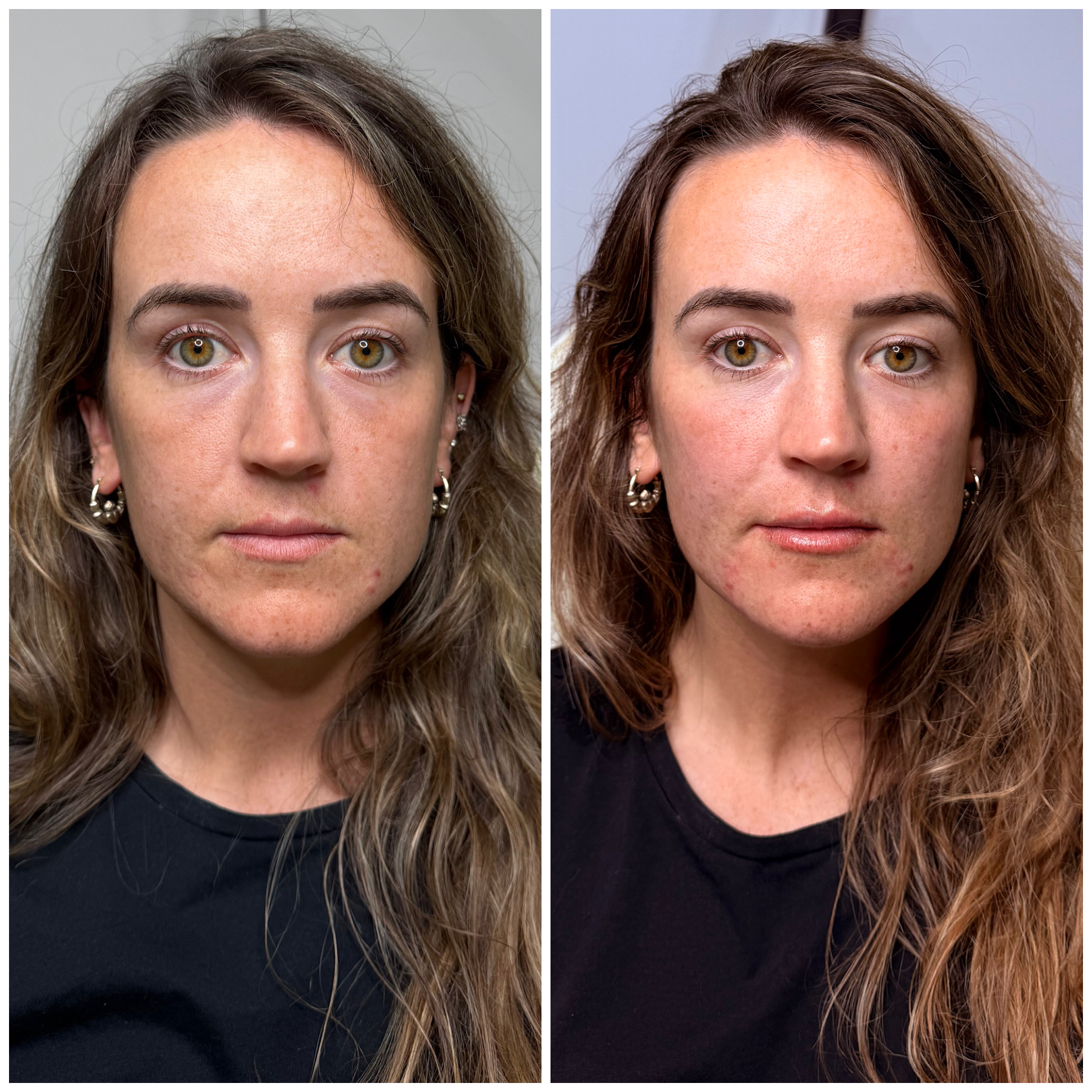 Before and after aesthetic treatment result
