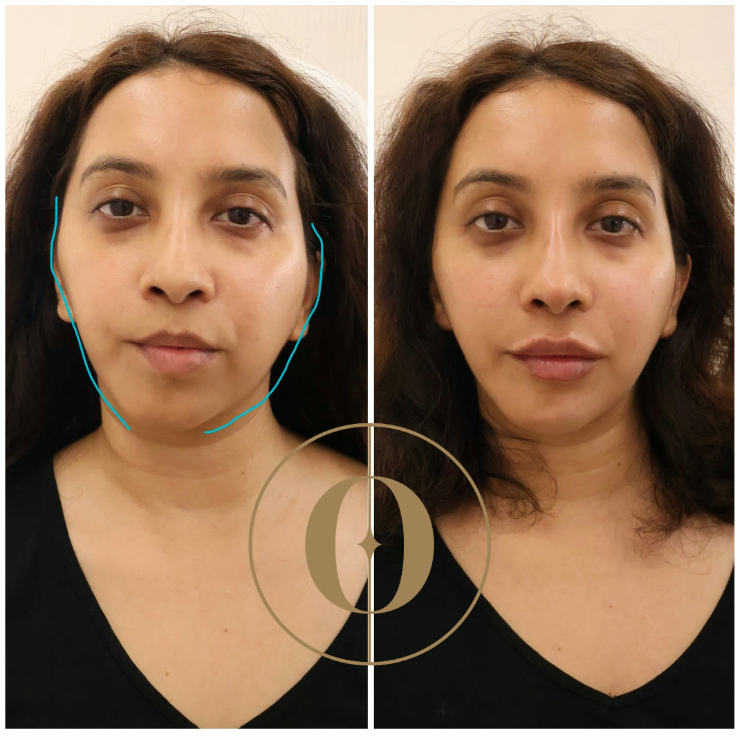 Treatment Spotlight:
